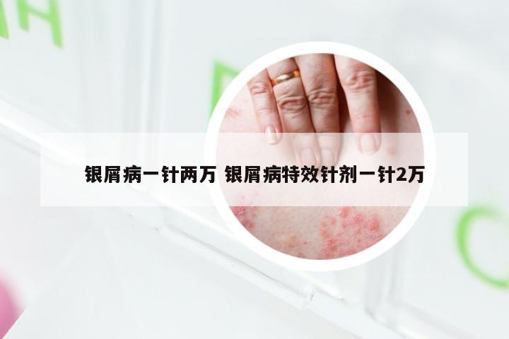 银屑病一针两万 银屑病特效针剂一针2万