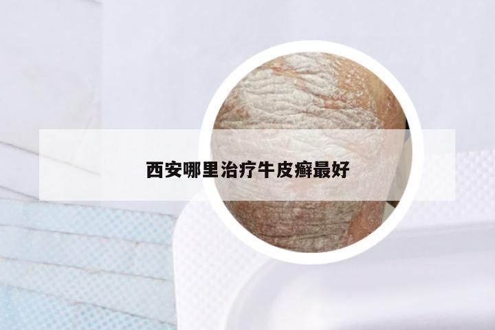 西安哪里治疗牛皮癣最好
