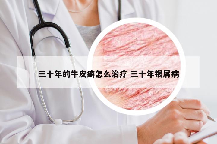 三十年的牛皮癣怎么治疗 三十年银屑病