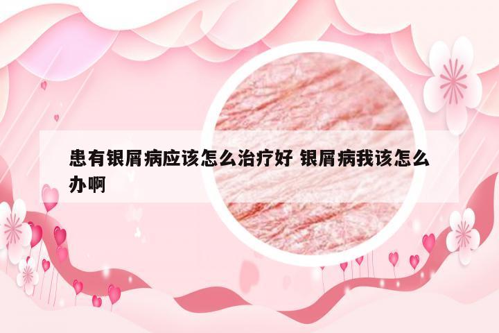 患有银屑病应该怎么治疗好 银屑病我该怎么办啊