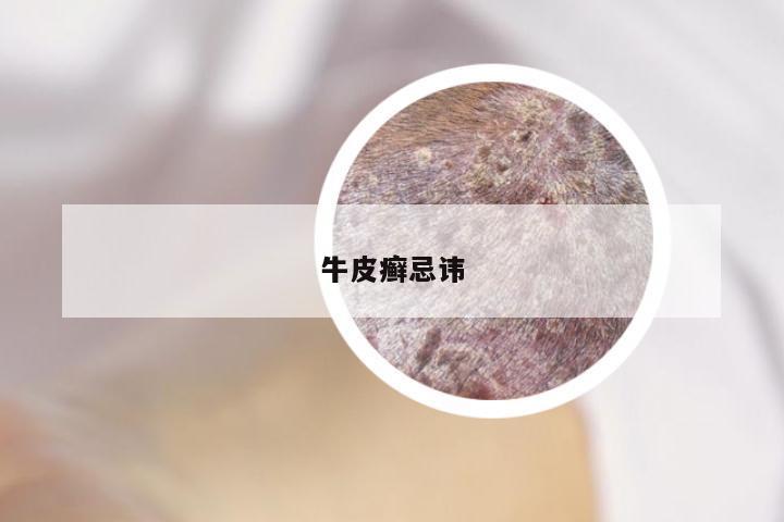 牛皮癣忌讳