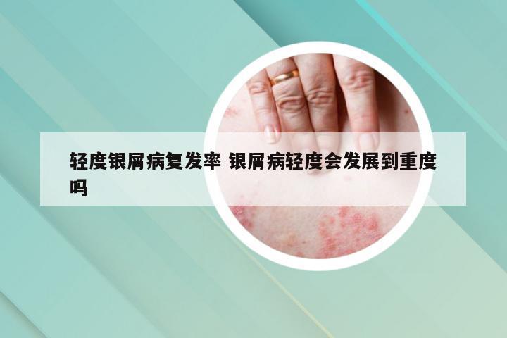 轻度银屑病复发率 银屑病轻度会发展到重度吗