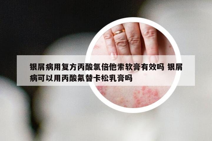 银屑病用复方丙酸氯倍他索软膏有效吗 银屑病可以用丙酸氟替卡松乳膏吗