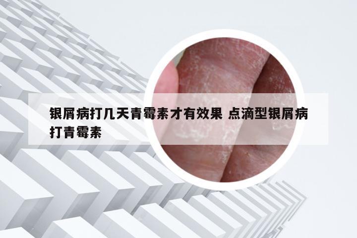银屑病打几天青霉素才有效果 点滴型银屑病打青霉素