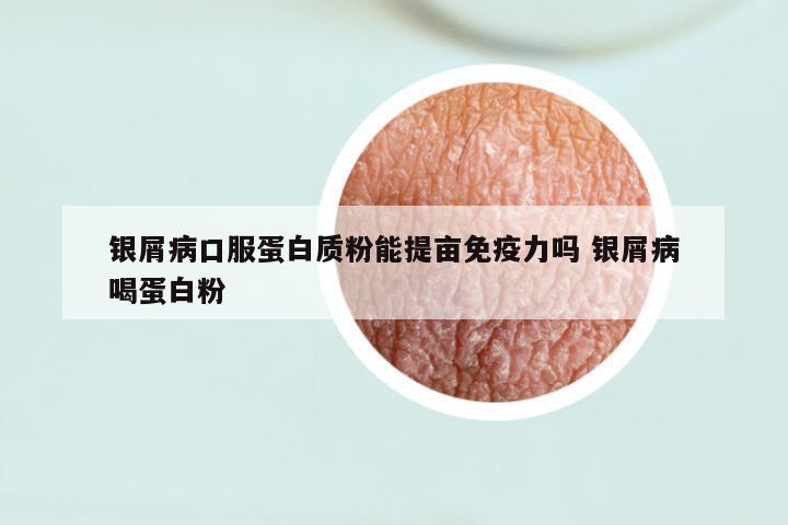 银屑病口服蛋白质粉能提亩免疫力吗 银屑病喝蛋白粉