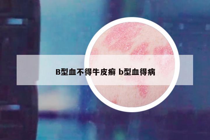 B型血不得牛皮癣 b型血得病