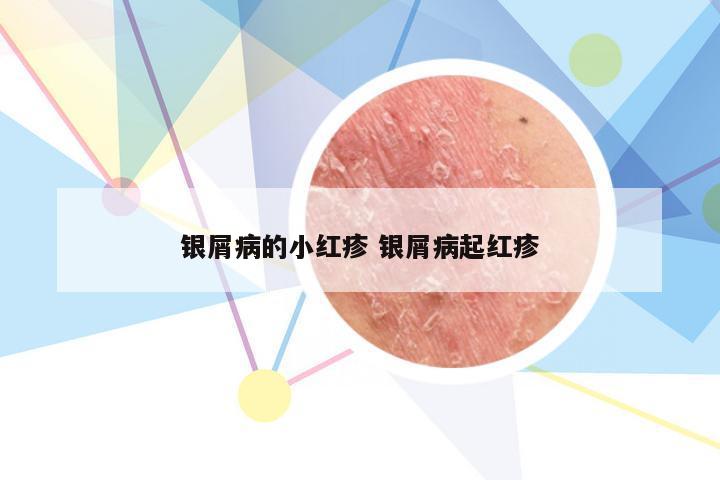 银屑病的小红疹 银屑病起红疹