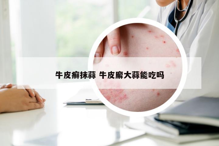 牛皮癣抹蒜 牛皮廨大蒜能吃吗