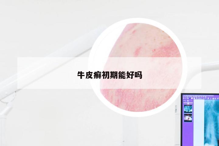 牛皮癣初期能好吗
