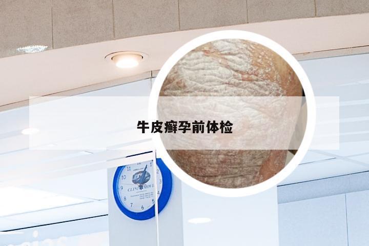 牛皮癣孕前体检