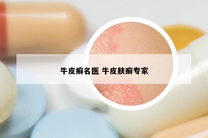 牛皮癣名医 牛皮肤癣专家