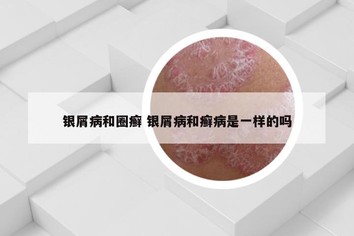 银屑病和圈癣 银屑病和癣病是一样的吗