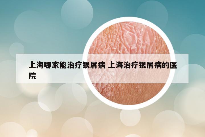 上海哪家能治疗银屑病 上海治疗银屑病的医院