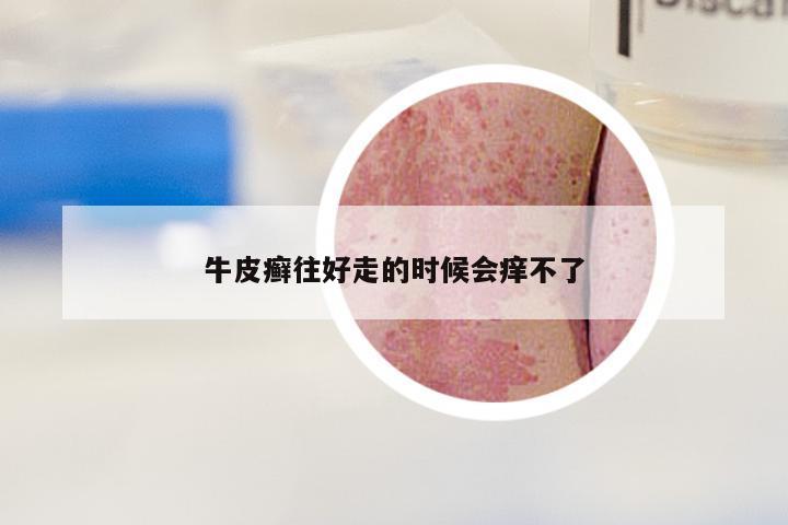 牛皮癣往好走的时候会痒不了