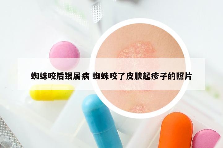 蜘蛛咬后银屑病 蜘蛛咬了皮肤起疹子的照片
