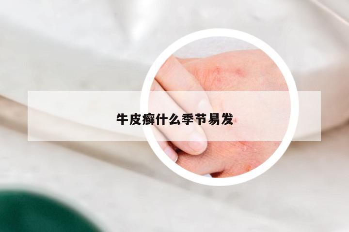 牛皮癣什么季节易发
