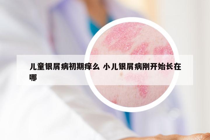 儿童银屑病初期痒么 小儿银屑病刚开始长在哪