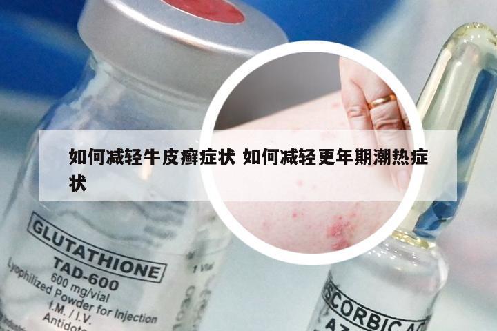 如何减轻牛皮癣症状 如何减轻更年期潮热症状