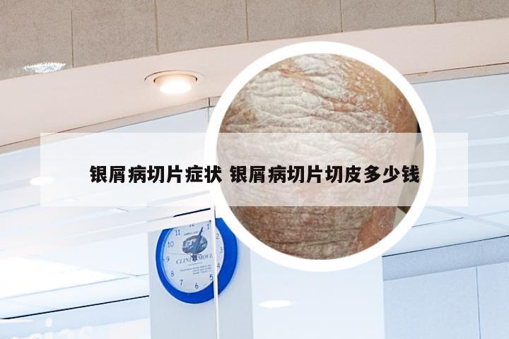 银屑病切片症状 银屑病切片切皮多少钱