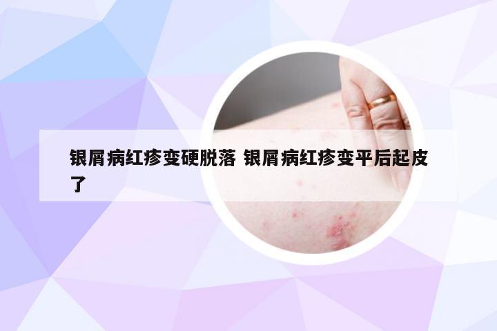 银屑病红疹变硬脱落 银屑病红疹变平后起皮了