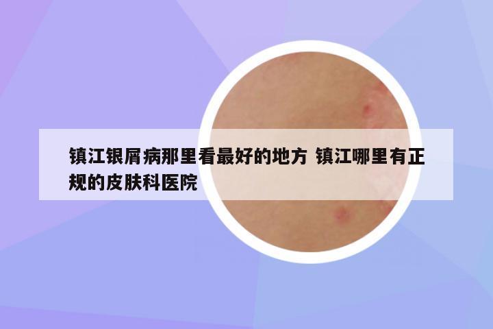 镇江银屑病那里看最好的地方 镇江哪里有正规的皮肤科医院