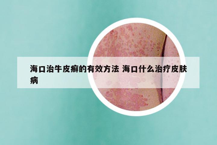 海口治牛皮癣的有效方法 海口什么治疗皮肤病