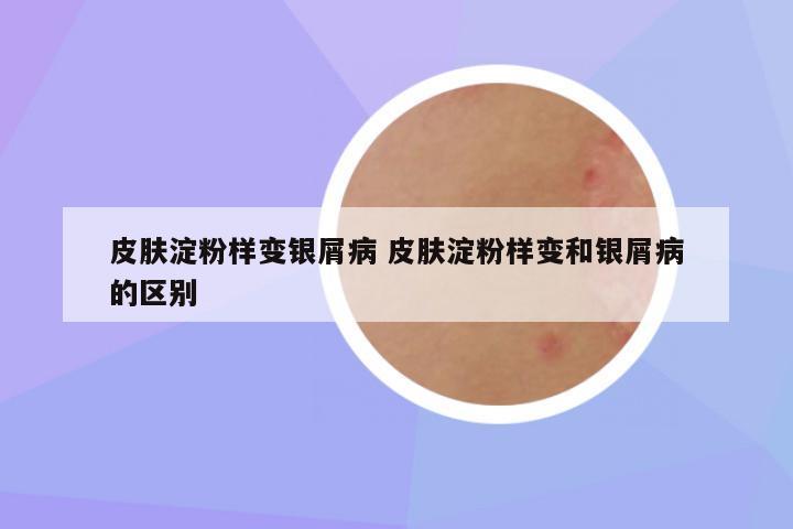 皮肤淀粉样变银屑病 皮肤淀粉样变和银屑病的区别