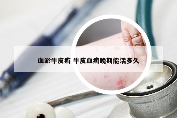 血淤牛皮癣 牛皮血癣晚期能活多久