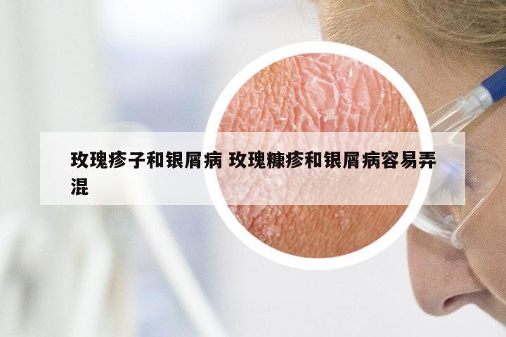 玫瑰疹子和银屑病 玫瑰糠疹和银屑病容易弄混