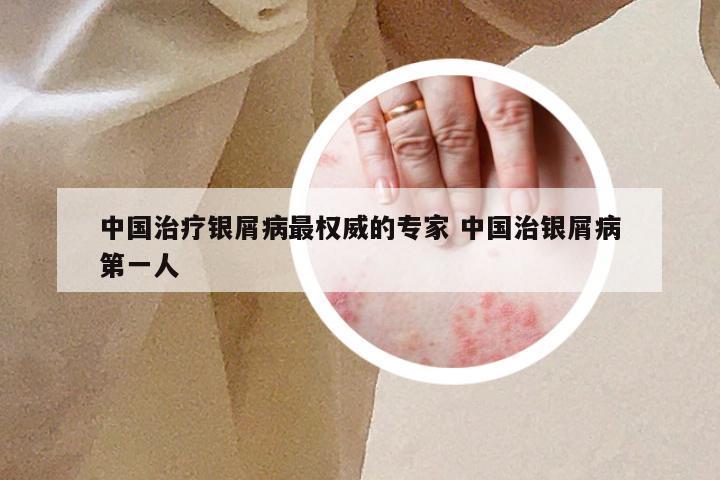中国治疗银屑病最权威的专家 中国治银屑病第一人
