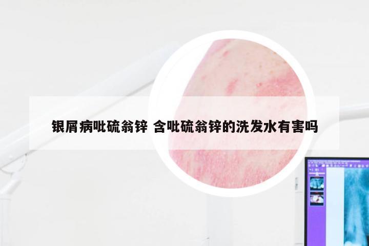 银屑病吡硫翁锌 含吡硫翁锌的洗发水有害吗
