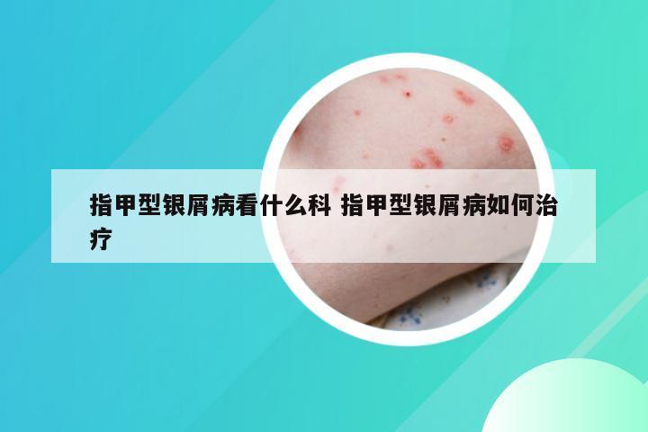指甲型银屑病看什么科 指甲型银屑病如何治疗