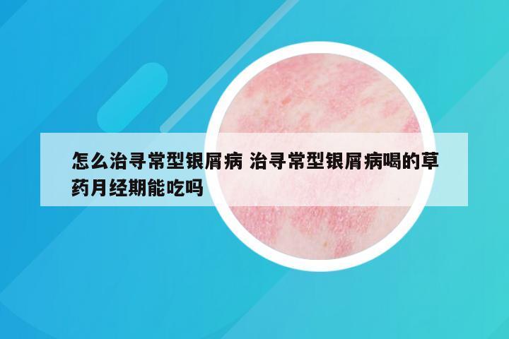 怎么治寻常型银屑病 治寻常型银屑病喝的草药月经期能吃吗