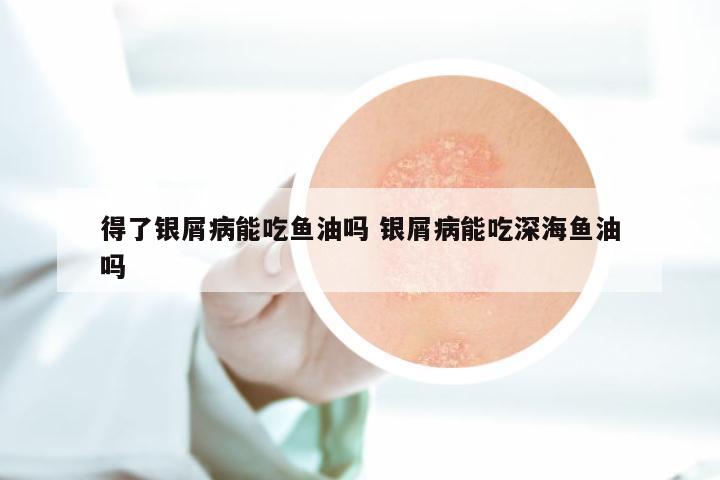 得了银屑病能吃鱼油吗 银屑病能吃深海鱼油吗