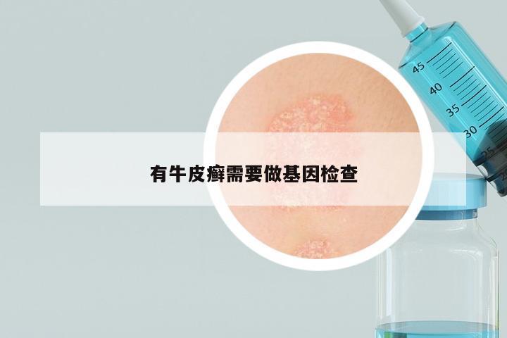 有牛皮癣需要做基因检查