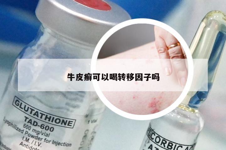 牛皮癣可以喝转移因子吗