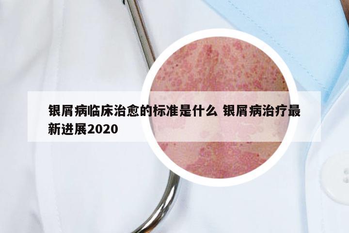 银屑病临床治愈的标准是什么 银屑病治疗最新进展2020