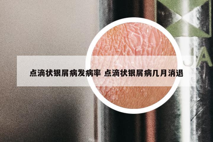 点滴状银屑病发病率 点滴状银屑病几月消退
