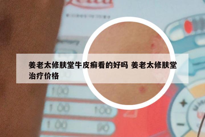 姜老太修肤堂牛皮癣看的好吗 姜老太修肤堂治疗价格