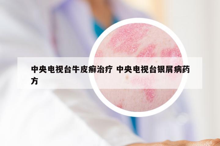 中央电视台牛皮癣治疗 中央电视台银屑病药方