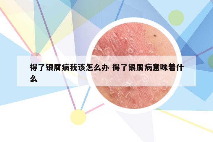 得了银屑病我该怎么办 得了银屑病意味着什么
