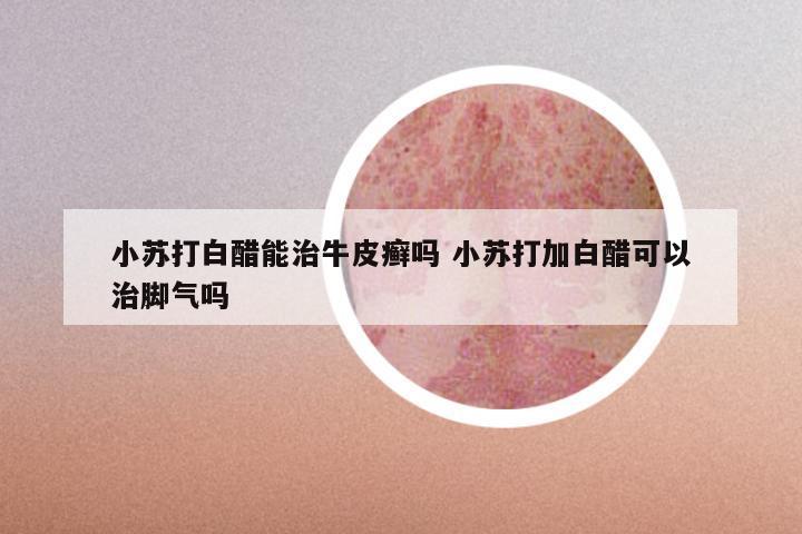 小苏打白醋能治牛皮癣吗 小苏打加白醋可以治脚气吗