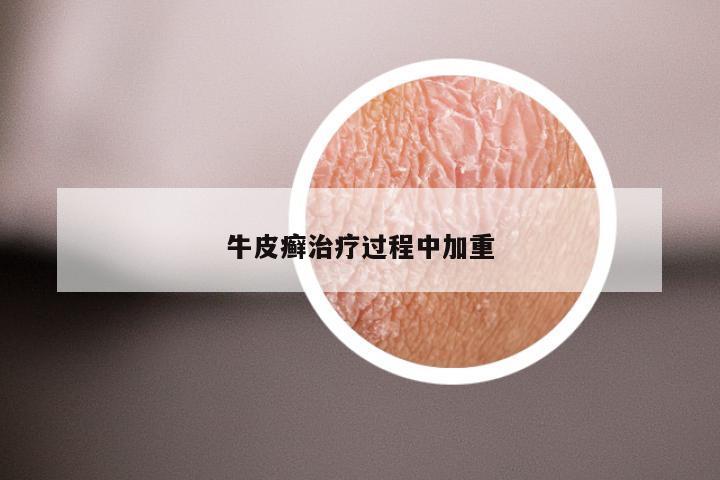 牛皮癣治疗过程中加重