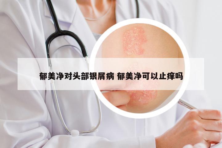 郁美净对头部银屑病 郁美净可以止痒吗