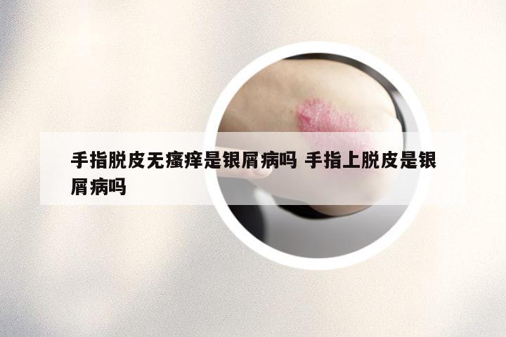 手指脱皮无瘙痒是银屑病吗 手指上脱皮是银屑病吗