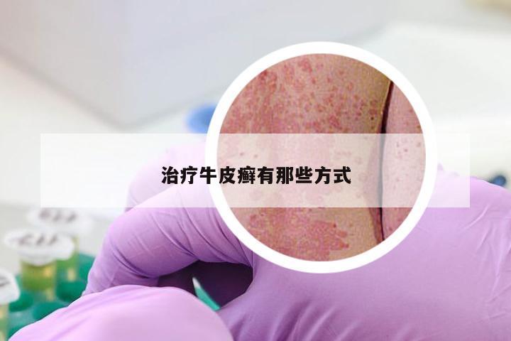 治疗牛皮癣有那些方式