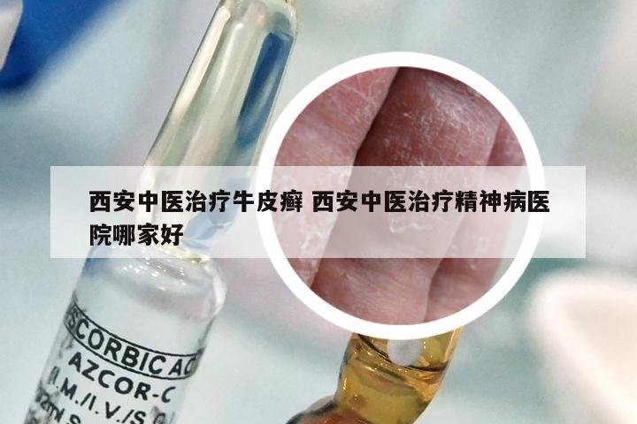 西安中医治疗牛皮癣 西安中医治疗精神病医院哪家好