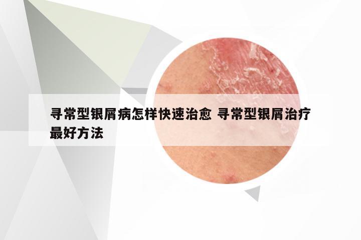 寻常型银屑病怎样快速治愈 寻常型银屑治疗最好方法