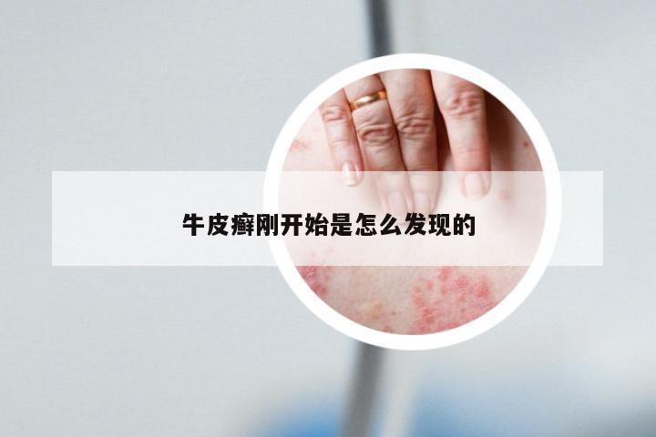 牛皮癣刚开始是怎么发现的