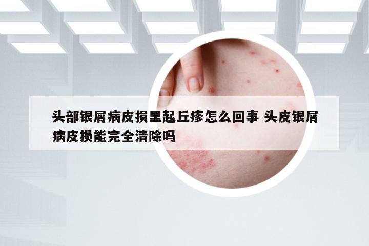 头部银屑病皮损里起丘疹怎么回事 头皮银屑病皮损能完全清除吗